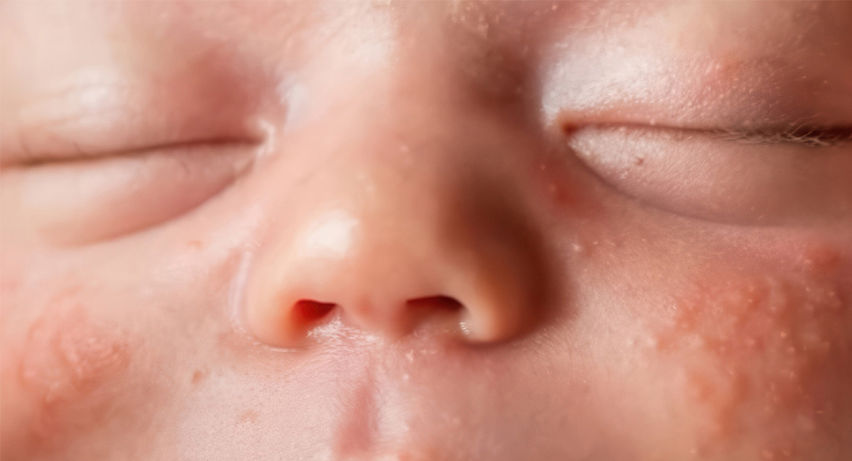 Granitos en la cara del bebé: ¿a qué se deben y qué hacer?